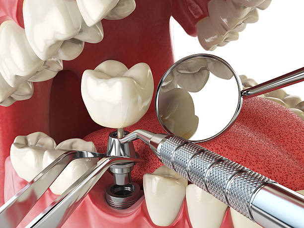 Best Emergency Treatment for Dental Infections or Abscesses in Knoxvle, IL